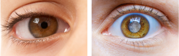 2 photos of an eye. The left one has a pupil that looks black. In the right one, the pupil area is unusually pale coloured.